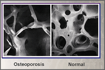 Resultado de imagen de imagen de hueso trabecular osteoporotico